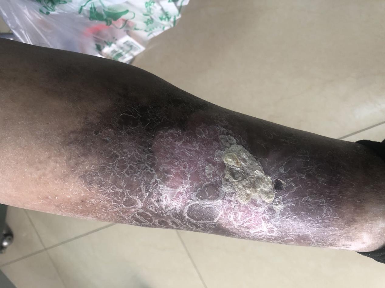 多重感染,性健康中不可忽视的风险与应对 多重感染,性健康中不可忽视的风险与应对
